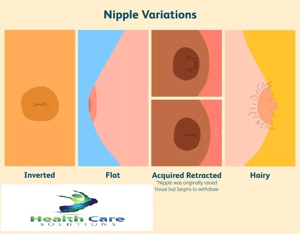 Types of Nipples
